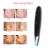 Picosure Pen Therapy Tattoo Scar Mole Freckle Removal Dark Spot Remover Machine Picosecond Pen Laser Acne Treatment Device